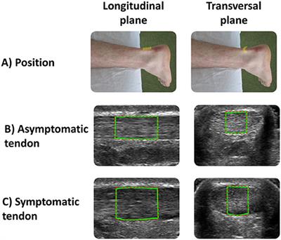 To What Extent Do Musculoskeletal Ultrasound Biomarkers Relate to Pain, Flexibility, Strength, and Function in Individuals With Chronic Symptomatic Achilles Tendinopathy?